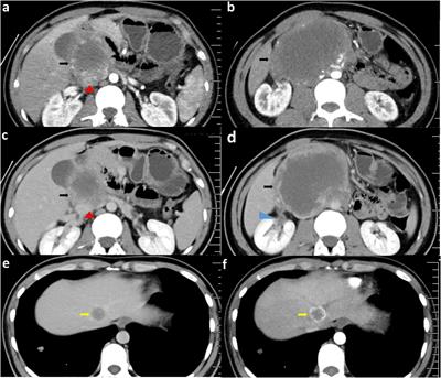 Case report: A case with atypical presentation oftesticular choriocarcinoma